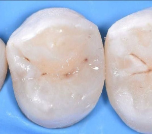 Скрытый кариес зубов (проксимальный)